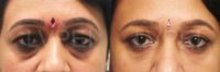 35-44 year old woman treated with Juvederm