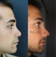 Man treated with Rhinoplasty