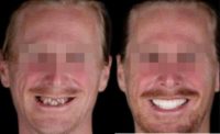 35-44 year old man treated with All-on-4 Dental Implants