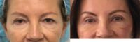 45-54 year old woman treated with Eye Bags Treatment