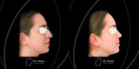 18-24 year old gender nonconforming person treated with Rhinoplasty