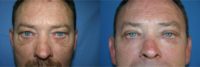 55-64 year old man treated with Eyelid Surgery