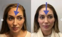 Woman treated with Rhinoplasty, Septoplasty