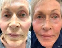 Woman treated with Laser Resurfacing