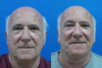 55-64 year old man treated with Neck Lift