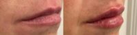Woman treated with Lip Fillers