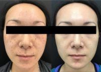 Woman treated with PicoSure