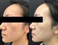 Woman treated with PicoSure