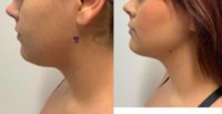18-24 year old woman treated with Vaser Liposuction