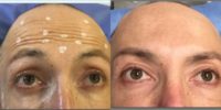 35-44 year old man treated with Botox