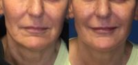 55-64 year old woman treated with Skin Rejuvenation