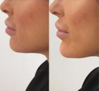 25-34 year old woman treated with Chin Filler