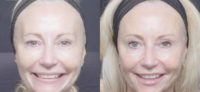 55-64 year old woman treated with Injectable Fillers