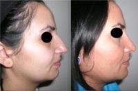 18-24 year old woman treated with Rhinoplasty