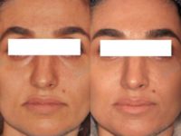 25-34 year old woman treated with Injectable Fillers