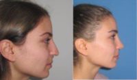 Woman treated with Rhinoplasty