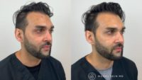 Man treated with Under Eye Fillers