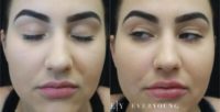 Upper Lip Augmentation: 18-24 year old woman