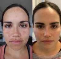 18-24 year old woman treated with Obagi Nu-Derm