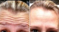 Female 40 years - Forehead wrinkle treatment