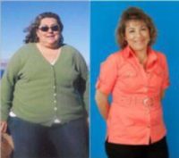 Female Gastric Bypass Patient Lost 175 lb