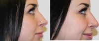 Female Non-Surgical Nose Job Results