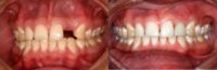 Female Receives Two Dental Implants