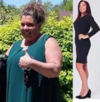 Woman treated with Gastric Sleeve Surgery