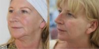 Woman treated with Nonsurgical Facelift, Dermal Fillers, Botox