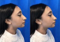 Woman treated with Rhinoplasty