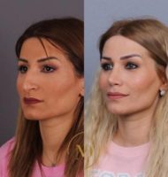 Woman treated with Rhinoplasty