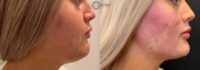 Woman treated with Chin Filler