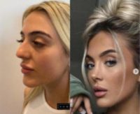 Woman treated with Rhinoplasty