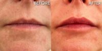 Woman treated with Lip Fillers