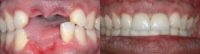 Male Before/After Dental Implants
