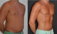 Male treated with Liposculpture