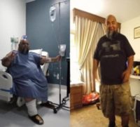 Man treated with Gastric Sleeve Surgery
