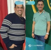 Man treated with Gastric Sleeve Surgery