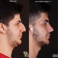 Man treated with Rhinoplasty