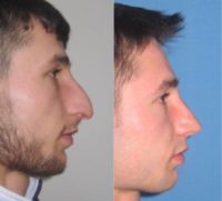 Man treated with Rhinoplasty