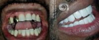 Man treated with Smile Makeover, Porcelain Veneers