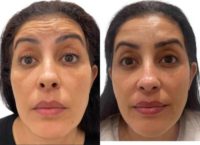 Woman treated with Botox