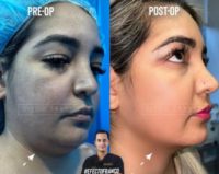 Woman treated with Chin Liposuction