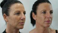 Woman treated with Nonsurgical Facelift, Botox