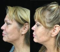 Woman treated with Voluma XC, Volbella XC and Juvederm Ultra XC