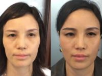 Woman treated with Dermal Fillers