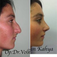 Woman treated with Rhinoplasty