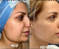 Woman treated with Chin Liposuction