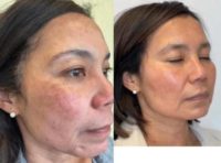 Woman treated with Laser Resurfacing