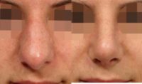 Over-projected nose treated with Rhinoplasty